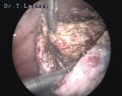 Sublimation of ovarian endometrioma. The cyst has been incised and is sublimated with SwiftLase. (laparoscopic image). 